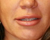 Feel Beautiful - Juvederm Ultra Plus 1 ml lip augmentation - Before Photo